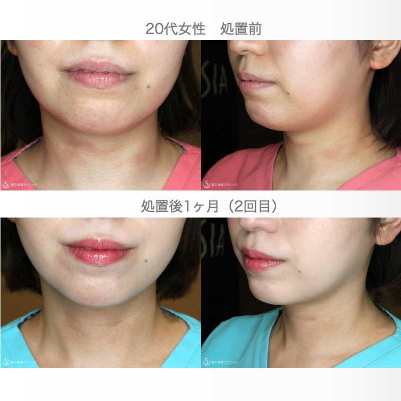 ボトックスによる、たるみ治療(ボトックスリフト)のビフォーアフター症例写真