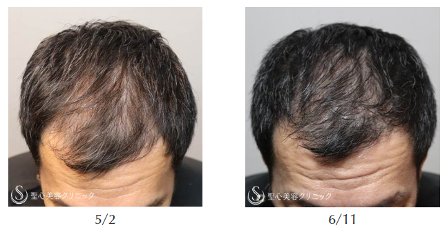 薄毛克服者800名からのアドバイスは「あきらめたらそこで試合終了」