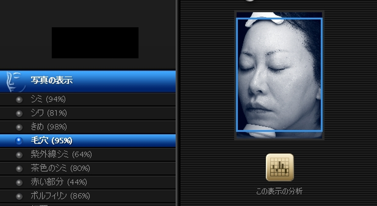 聖心美容クリニックでは、「肌育」注射の前後を、肌診断機VISIAで測定。効果を数値と画像で確認しています