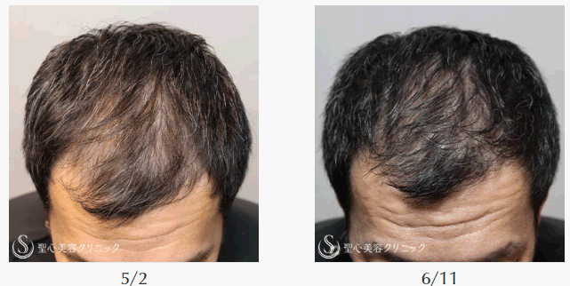 聖心美容クリニックの鎌倉達郎統括院長は自身の薄毛を「EXOHAIR Evs」で治療。その症例写真を公開